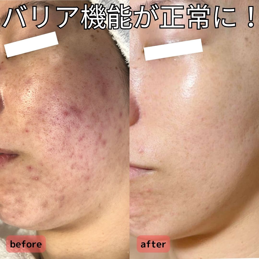 幸せホルモンで美肌になるって知ってた？/Stress-Free Skin Care Tips